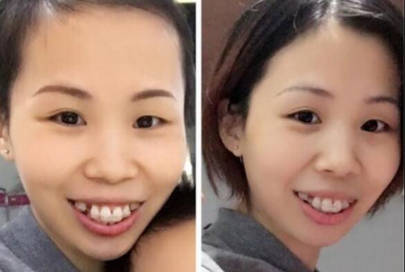 牙齿矫正的很好的年龄，多对比图真实案例分享——成都格林口腔