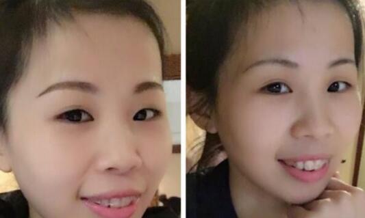 牙齿矫正的很好的年龄，多对比图真实案例分享——成都格林口腔