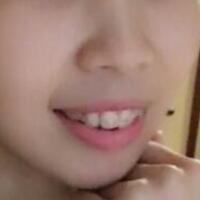 牙齿矫正的适宜年龄，多对比图真实案例分享——成都格林口