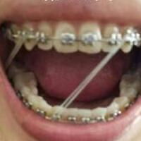 成人牙齿矫正费用9800元——成都格林口腔医院