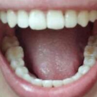 成人牙齿矫正费用9800元——成都格林口腔医院