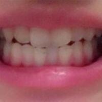 成都矫正牙齿案例分享——成都格林口腔医院