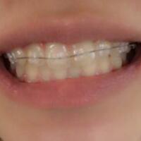 成都矫正牙齿案例分享——成都格林口腔医院