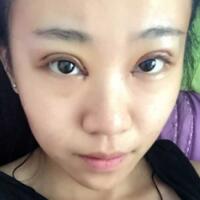 在成都魅丽经纬做单眼皮变双眼皮整形恢复过程和对比图分享