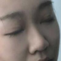 在成都魅丽经纬做单眼皮变双眼皮整形恢复过程和对比图分享