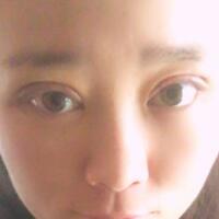 割双眼皮前后对比图和恢复过程——成都魅丽经纬整形医院