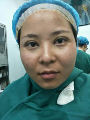 深圳南西子袁新平医生做的割双眼皮+开眼角前后恢复过程图片分享