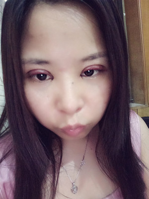 深圳南西子袁新平医生做的割双眼皮+开眼角前后恢复过程图片分享