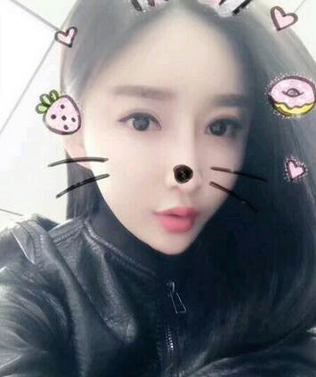 武汉西婵康美假体隆鼻+眼部综合整形