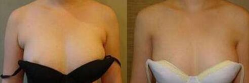 副乳手术前后图片，腋下副乳手术价格