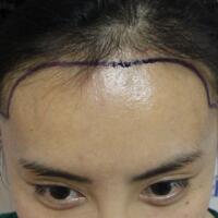 种头发有用吗？种植头发恢复过程真实案例——南京明基医院