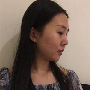 光子嫩肤手术前后过程以及对比照片分享，武汉美都朱红霞医生做的