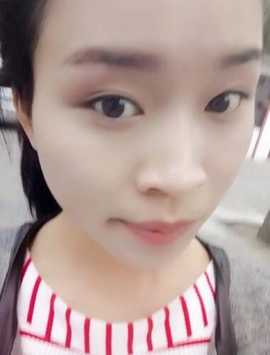 长安医院卢丙仑教授V-line瓜子脸手术前后对比