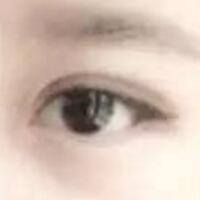 单眼皮变双眼皮整容日记——厦门安黛美整形医院