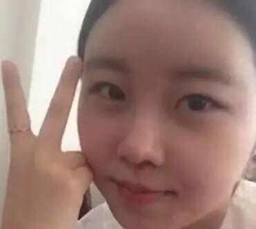 双眼皮整形前后对比图,单眼皮变双眼皮整容日记