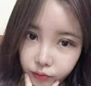 双眼皮整形前后对比图,单眼皮变双眼皮整容日记