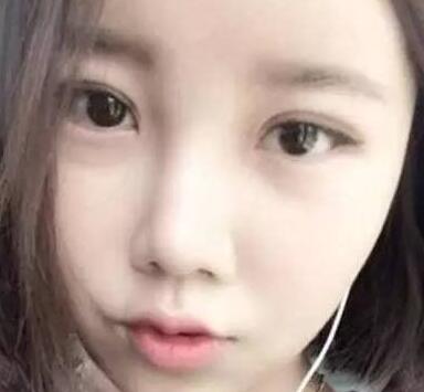 双眼皮整形前后对比图,单眼皮变双眼皮整容日记