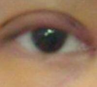 厦门割双眼皮+开眼角整形过程恢复对比图——安黛美整形医院