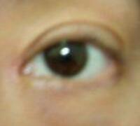 厦门割双眼皮+开眼角整形过程恢复对比图——安黛美整形医院