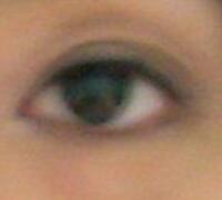 厦门割双眼皮+开眼角整形过程恢复对比图——安黛美整形医院