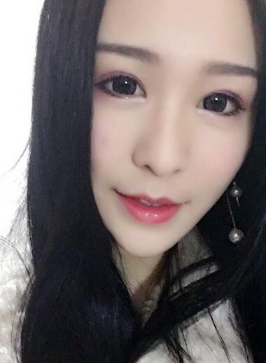 杭州大麦微针龙都整形开眼角+割双眼皮恢复记录