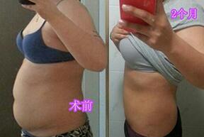 吸脂减肥前后对比图