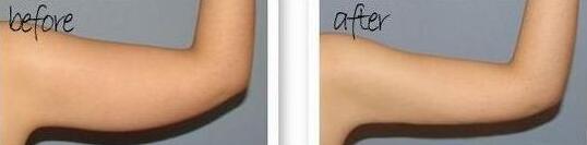 吸脂减肥瘦手臂前后对比图