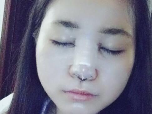 隆鼻整形价格和真实恢复期图片