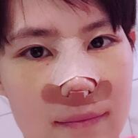 杭州悦可整形医院做隆鼻失败修复恢复过程和对比图分享