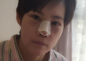 杭州悦可整形医院做隆鼻失败修复恢复过程和对比图分享