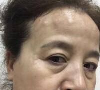 去抬头纹方法？杭州悦可整容推荐注射瘦脸去抬头纹鱼尾纹