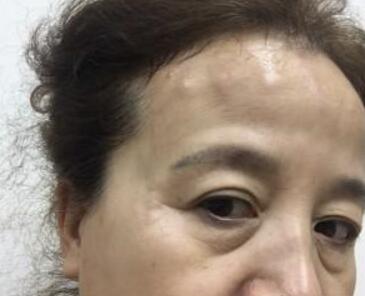 去抬头纹很好的方法？注射瘦脸去抬头纹鱼尾纹