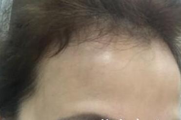 去抬头纹很好的方法？注射瘦脸去抬头纹鱼尾纹