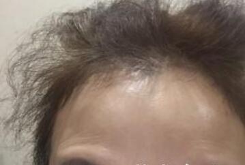 去抬头纹很好的方法？注射瘦脸去抬头纹鱼尾纹