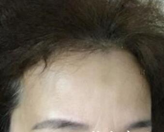 去抬头纹很好的方法？注射瘦脸去抬头纹鱼尾纹