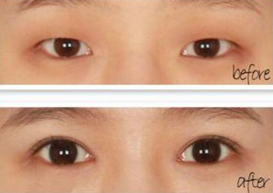 高分子埋线双眼皮果图和价格