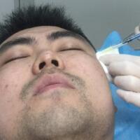 男生注射注射瘦脸去除抬头纹鱼尾纹案例分享——杭州悦可整形