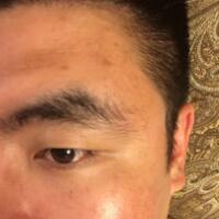 男生注射注射瘦脸去除抬头纹鱼尾纹案例分享——杭州悦可整形