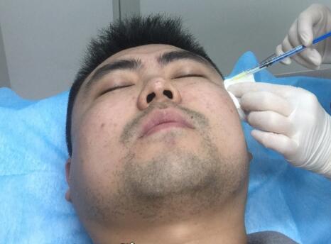 男生注射注射瘦脸去除抬头纹鱼尾纹案例分享