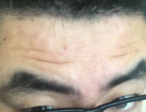 男生注射注射瘦脸去除抬头纹鱼尾纹案例分享