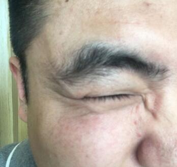 男生注射注射瘦脸去除抬头纹鱼尾纹案例分享