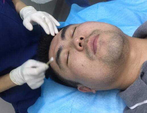 男生注射注射瘦脸去除抬头纹鱼尾纹案例分享