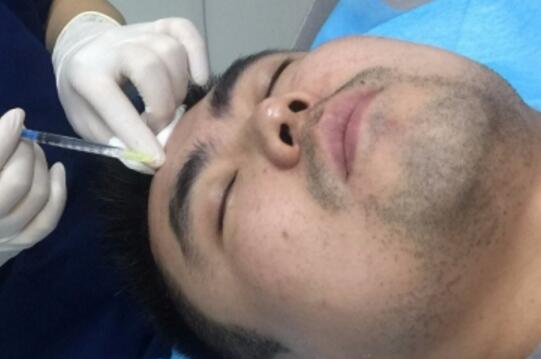 男生注射注射瘦脸去除抬头纹鱼尾纹案例分享