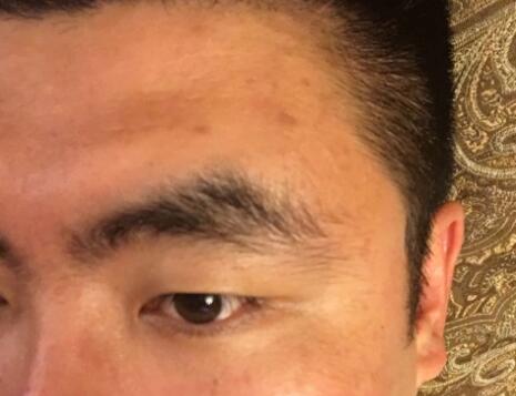 男生注射注射瘦脸去除抬头纹鱼尾纹案例分享