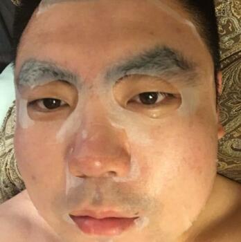 男生注射注射瘦脸去除抬头纹鱼尾纹案例分享