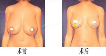 巨大乳房缩小术成好吗?手术前后对比图