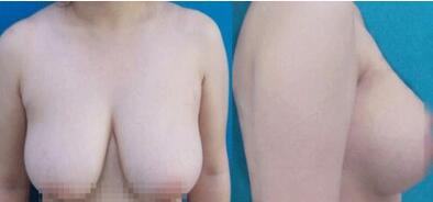 巨大乳房缩小术成好吗?手术前后对比图