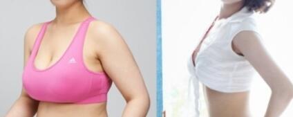 巨大乳房缩小术成好吗?手术前后对比图