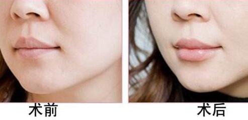 丰唇降低风险吗?果好不好?多少钱?