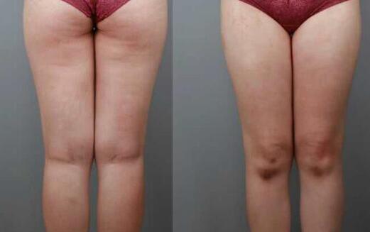 吸脂减肥瘦大腿前后对比图，光纤溶脂瘦大腿较有的方法真实案例